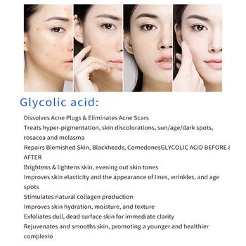 Kyseliny glykolovej 40% glicolico aha pokožky glicolic kyseliny peeling na odstránenie akné pockmark peeling liečba Späť blain blain whelk tvár