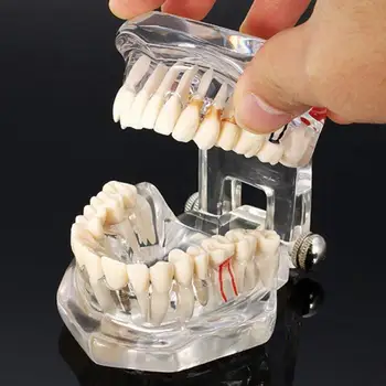 Zubné Ústnej Hygieny Implantát Ochorenia Zubov Model pre Lekárske Vyučovanie PVC/živice Ústne Zdravie, Starostlivosť o Zuby, Bielenie Zubov Model
