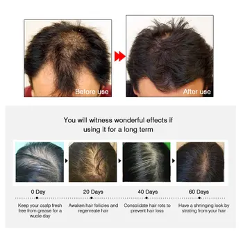ARTISCARE Rast Vlasov Esenciálny Olej Liečba Anti-Alopécia Opraviť Poškodené Vlasy Starostlivosť Vlasov Regenerácia Podstate Liuqid