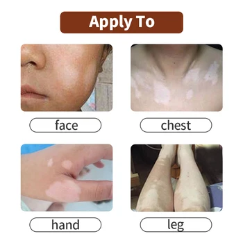 Lekárske Vitiligo Sprej Leukoplakia Ochorenia Opravy Kvapaliny Dermalight Vitiligo Liečba Podpora Kožné Farbivo Melanín Starostlivosť