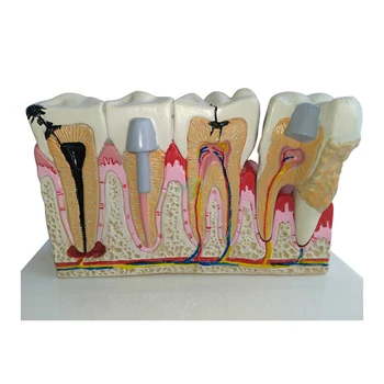 1pcs Zubné Zub Zuby Anatomický Model Zubné Anatómia Zubov Model Nadrozmerné Anatómie