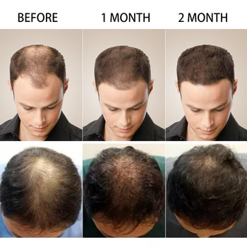 2 ks PURC Rýchly Rast Vlasov Podstate Olej Liečbu vypadávanie Vlasov Pomoc pre Rast vlasov Starostlivosť o Vlasy 20ml
