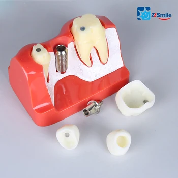 Zubný Implantát Zuby Model/Implantát Opravy Model M2017R