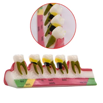 Zubného kazu zuby skazená zubného kazu zubného kazu klasifikácia klasifikovať sortiment Model