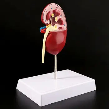 Lekárske rekvizity model životnej Veľkosti Ľudskej Obličky Choré Model Anatomický Anatómie Choré Patologické Kameň Orgán Spotrebný materiál na Vyučovanie