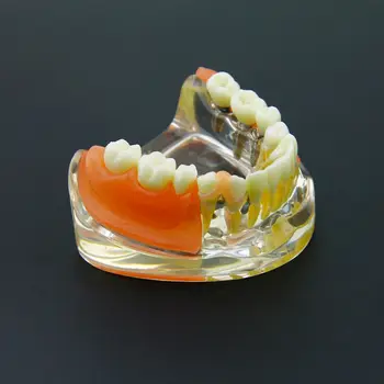 Zubný Implantát Obnova Zuby Model Vymeniteľné Most Protézy Demo #6006